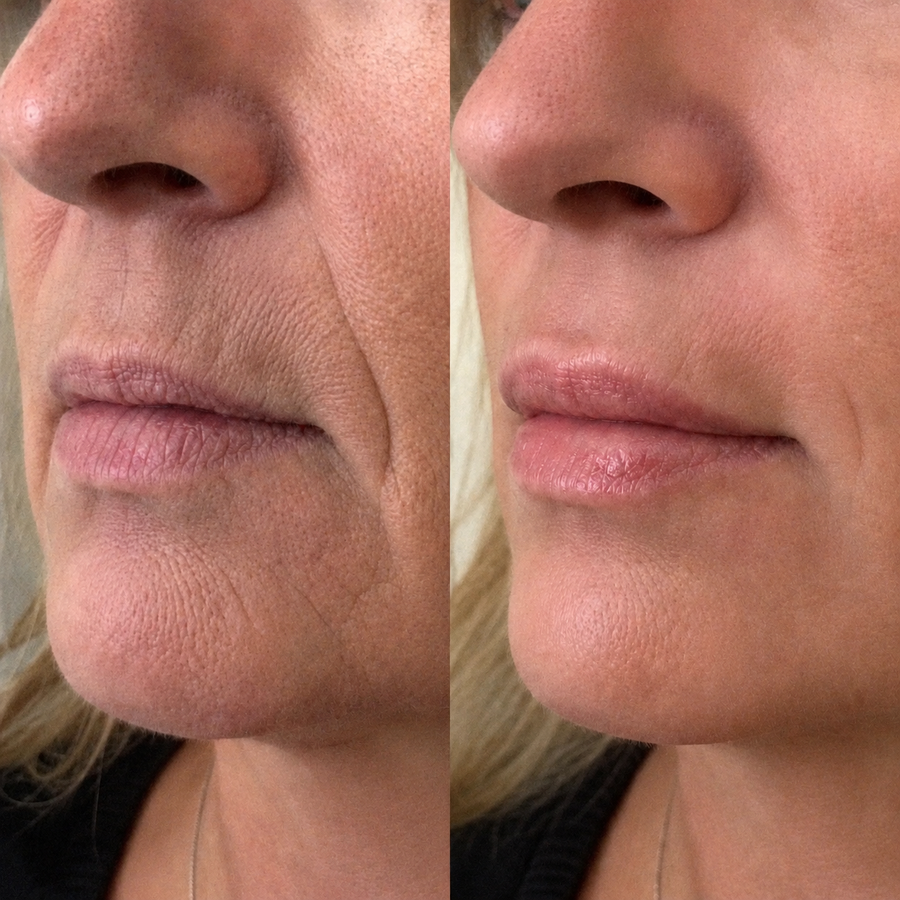 Dünne & faltige Lippen