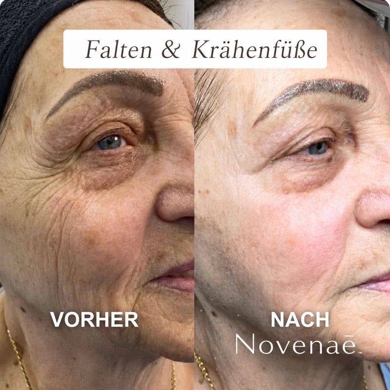 Das Micro- Infusionssystem™