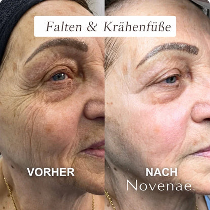 Das Micro- Infusionssystem™